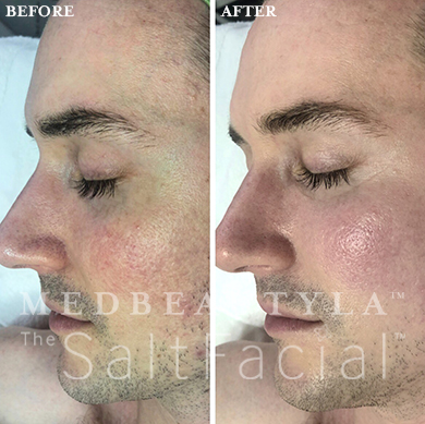 saltfacial treatment before and after